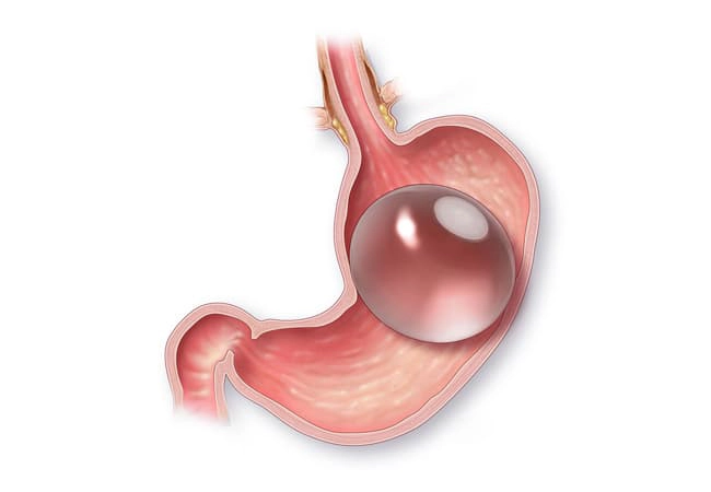 balon gastrico
