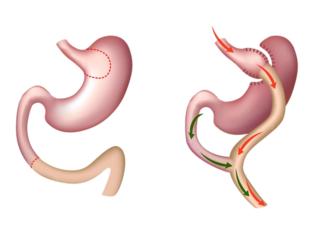 bypass gastrico